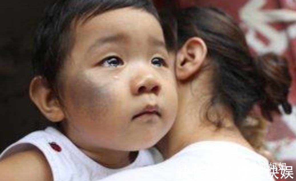 血管瘤|越来越多胎儿被“胎记”缠身,若不想孩子自卑,孕妈要管住自己