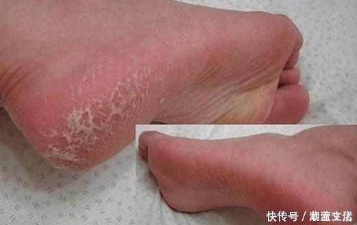秘方|脚上老皮、老茧又干又硬!一个民间小秘方学会,双脚变的白白嫩嫩