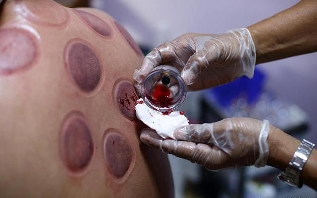 拔火罐可以排毒嗎？至少它這6大功效，還是名副其實(shí)的