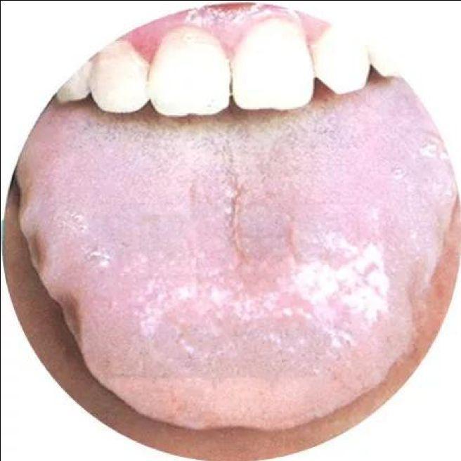 舌体|舌头有齿痕,就是有湿气这是误解,请不要再传播了