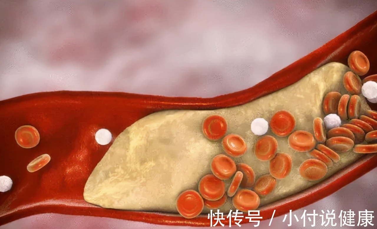 饱和脂肪酸|鸡蛋是高血脂的“发物”?建议:预防血脂升高,这3种食物需少吃