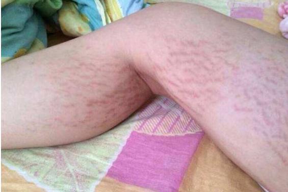 宝妈|妊娠纹是如何形成的丈夫们都该来看看,母亲的苦难应该被理解