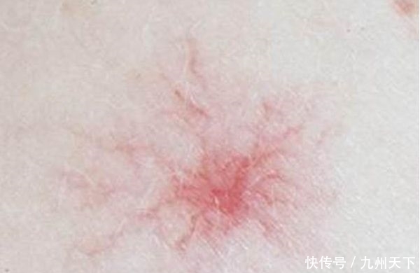 种菜|中医:肥胖引发脂肪肝,多喝1种汤,多吃1种菜,肚子慢慢消