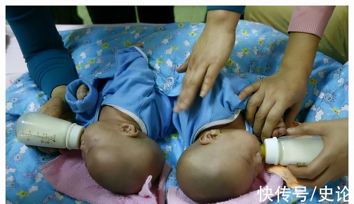 浙大儿童医院|22年前轰动一时的连体女婴，分离术后姐姐去世，妹妹如今结婚生子