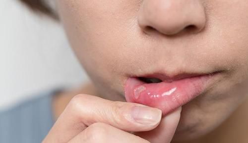 口腔溃疡|为什么总会得口腔溃疡,可能离不开3个原因,一起来了解下