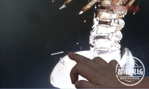 梁婆婆|67岁老人自行针灸,针断腹中!她又想自己开口子取出