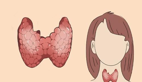 肿瘤|肿瘤医生:身体频繁有3个迹象,或是甲状腺癌“一级预警”