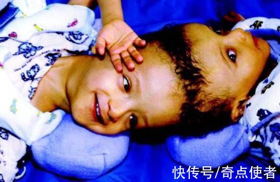 马耳他|连体婴儿的悲剧：想要救活姐姐，就只能杀死妹妹，这算不算谋杀？