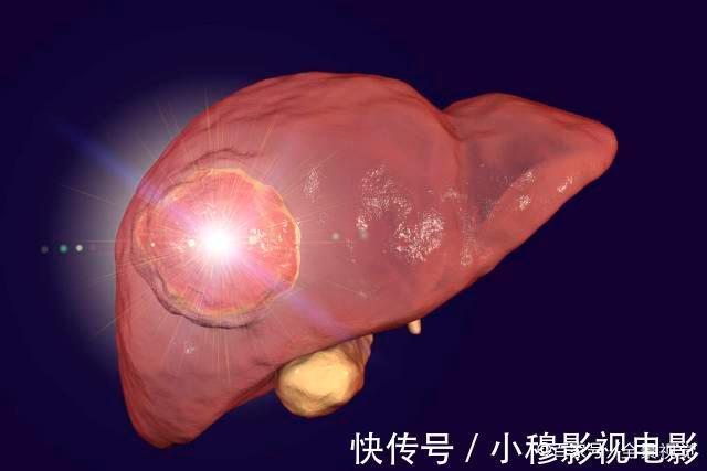 肝癌|36夫妻相继患癌,2个月后离世,医生:吃饭用的这些东西,快扔掉