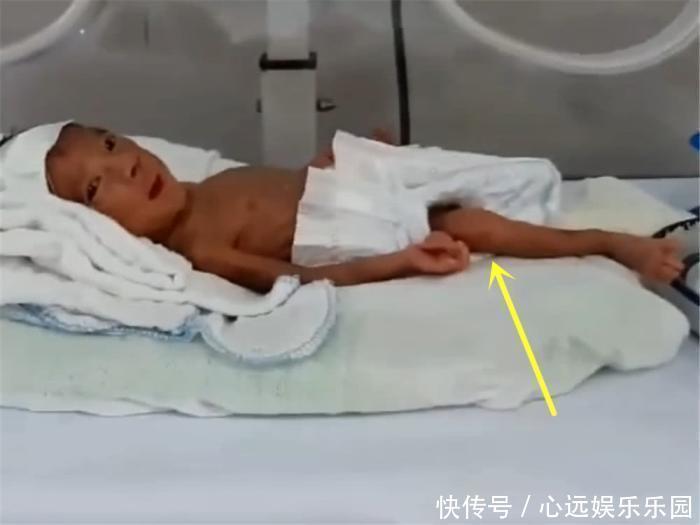 宝宝|重900克的早产儿,第一次见妈妈就笑了,宝宝的腿却让妈妈泪崩