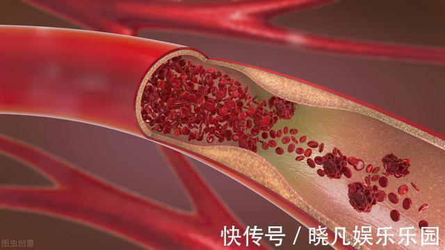 药物|心脑血管疾病的“冠军药”,你都清楚吗?医生列详细,值得收藏