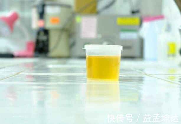 尿液|尿酸过高时,身体会有哪三种异常表现,希望引起大家的重视