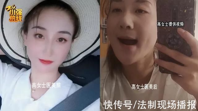 高女士|杭州23岁女子做医美，脸上发生奇怪变化:上下嘴唇对不齐了