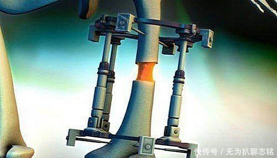 武大郎|为实现长高梦想,花16万断骨增高的李亚诺,如今过得快乐吗