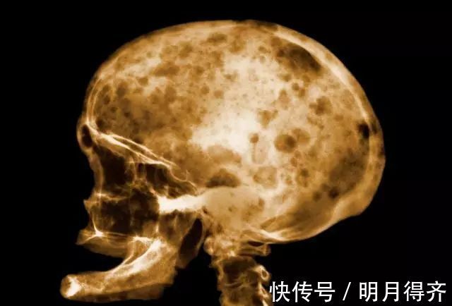 癌症|腰痛、贫血、抵抗力下降...你还不在意小心被这种癌症“盯”上