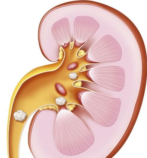 肾脏|什么是尿毒症?尿毒症是怎么引起的?尿毒症可以治愈吗?