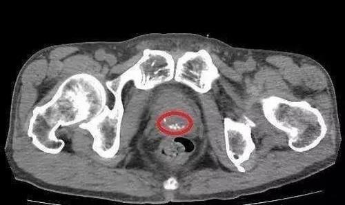  前列腺|前列腺钙化怎么办？