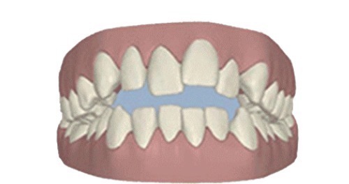 黄金期|孩子牙齿矫正,必须要12岁以后吗?你是否错过了孩子的矫正黄金期