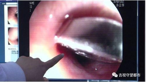 三岁男童频呛咳，竟是西瓜籽惹的祸...