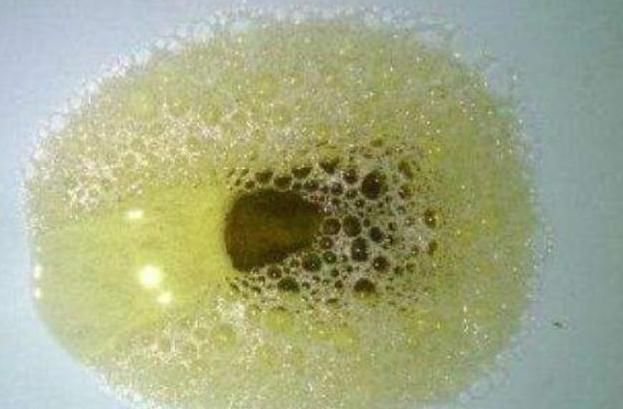 蛋白质含量|血糖是否高,看尿就知道了如果尿中有三种情况,可能糖尿病来了