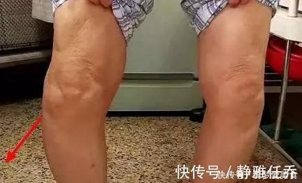 慢跑|夫妻双双膝盖废了，疼痛犹如分娩，只因长期这么做……