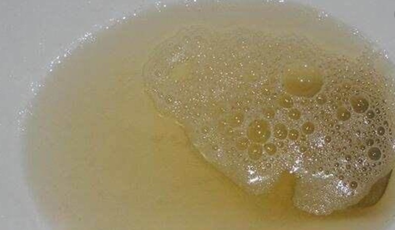 泡沫|男人晨起“第一次小便”，若无3个表现，偷乐吧，肾脏很强壮