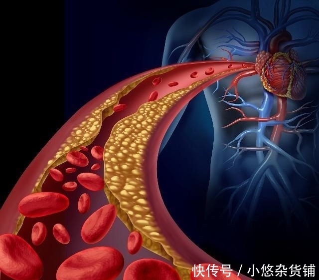 牢记|血栓出现时几乎无征兆,牢记一个“字”,助你一生无“栓”!