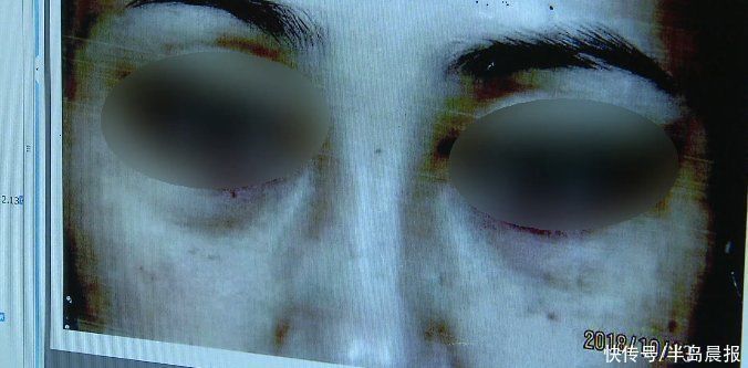 疤痕|女子花百万医美却疤痕累累!告上法庭,终审判了