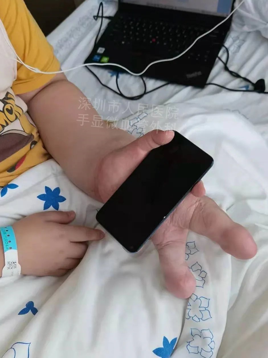 发育不良|得了这病,12岁男孩手指比香蕉还粗!7种常见的手部畸形,家长们要注意