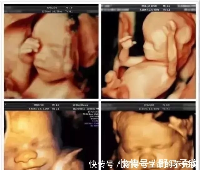 宝宝|为什么我的四维彩超图像没有别人的清晰?