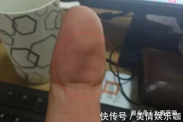 信号|大拇指上暗藏中风信号!出现这种横纹,可能离中风不远了,要重视