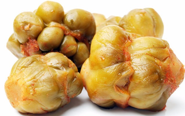 腌菜|母子二人先后查出胃癌,丈夫痛哭,专家很多家庭常犯的错!