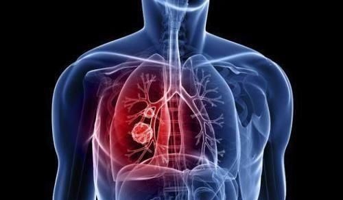 体检|55岁男子,体检正常5个月后查出晚期肺癌去世体检到底有何用