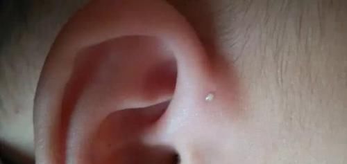 新妈妈|宝宝耳朵有“聪明孔”,妈妈忍不住挤了一下,医生摇头动手术吧