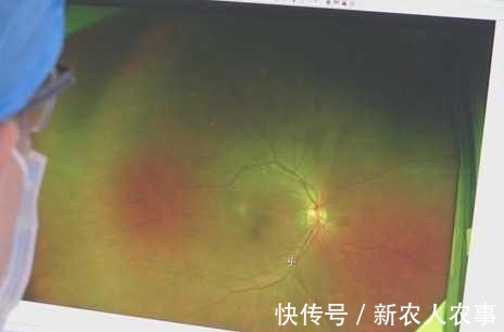 眼睛|广东一男子周末“钓鱼自由”，结果眼睛躺枪，网友：不幸中的万幸