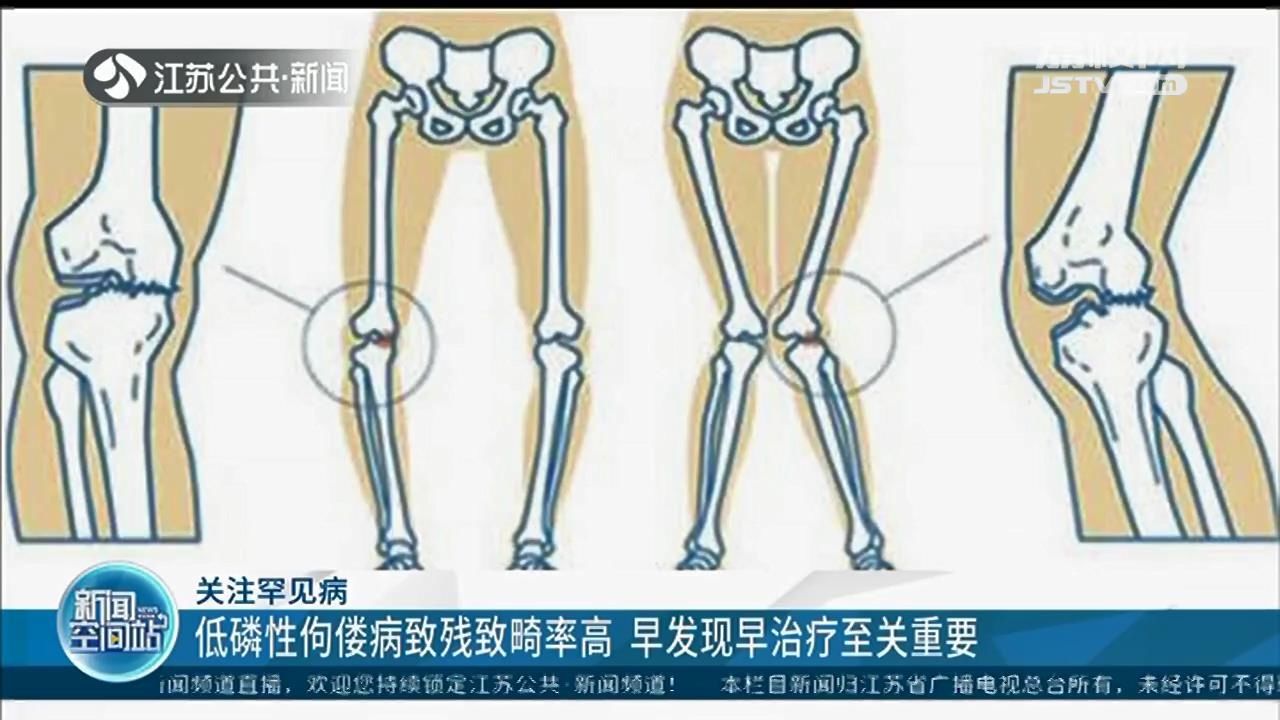 张爱华|关注罕见病：低磷性佝偻病致残致畸率高 早发现早治疗至关重要