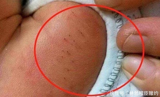 孩子|刚出生宝宝身上有“黑刺”,宝妈细心全拔掉,医生斥责太无知