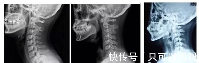 颈椎病|矿泉水瓶对颈椎病竟有妙用原理在哪