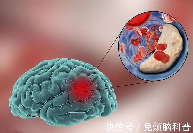 血管|中老年人，三伏天要警惕热中风，注意这四点，更好远离心脑血管病