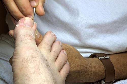 偏高|血脂高不高,看脚就知道,四个方法让你血管畅通