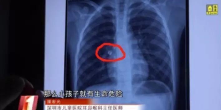 银饰品|过生日毁了孩子一只手!家人反目:谁让你给娃送这个?