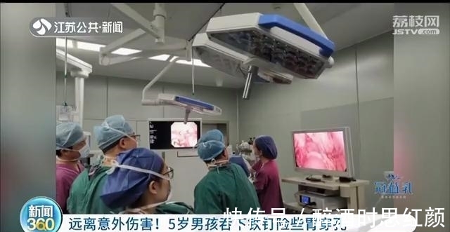 钉子|5岁男孩误吞下铁钉 一个月后,被胃酸腐蚀变粉碎