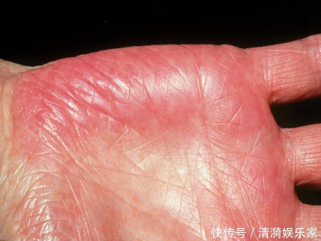 早晨是养肝“黄金期”，尽量做到这三点，助你有效“抵御”肝病