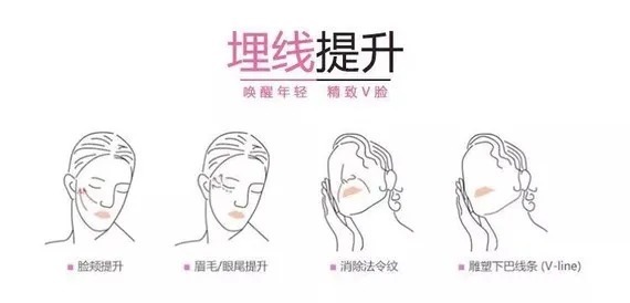 科普 医美知识科普|面部埋线提升——让脸型变得好看
