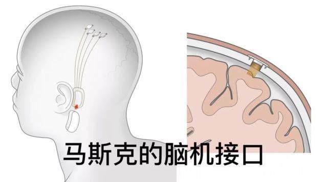 马斯克|马斯克又来宣传脑机接口了，我们能让瘫痪患者再次行走