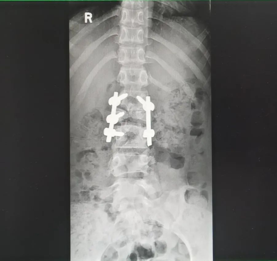 手术|十堰13岁女孩坐下时，家人发现不对劲！医生：要截骨