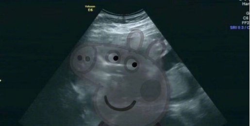 子宫内|孕24周B超检查,当看到宝宝的样子后,孕妈有些吓到了