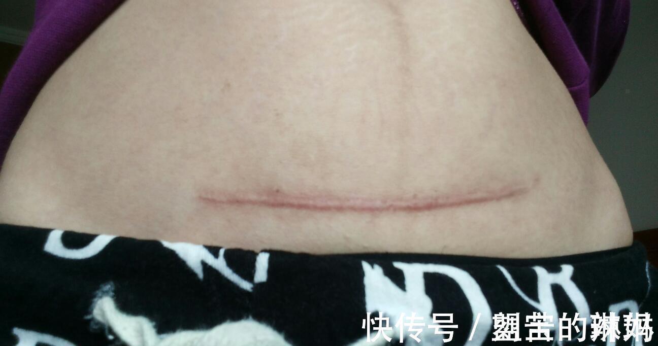 产妇|剖宫产“横竖”怎么选择?哪个更有利于产后恢复?医生教你这么选