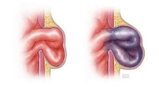 腹股沟疝|【健康科普】这种病50%“嵌”在冬季