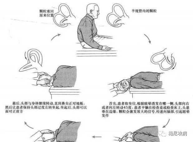 疾病|耳石症是一种什么疾病?有哪些治疗方法?